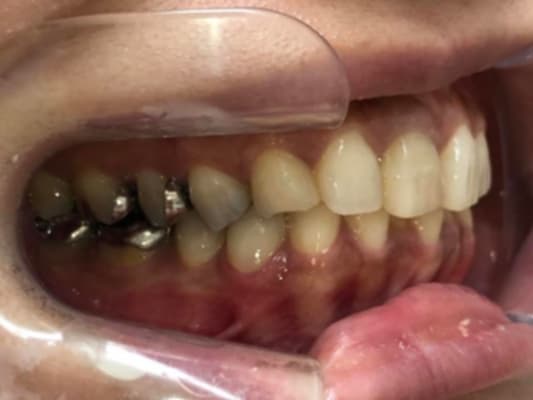 審美歯科のオンライン診断用写真