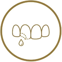 ダイレクトボンディング