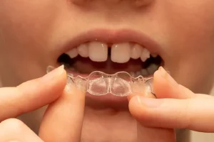 すきっ歯はマウスピース矯正で治るのか？