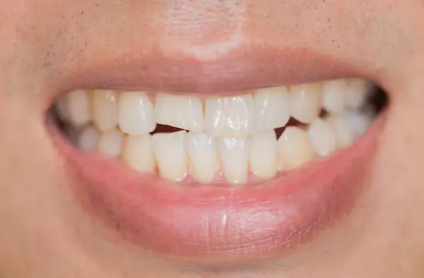 歯並びの判る写真