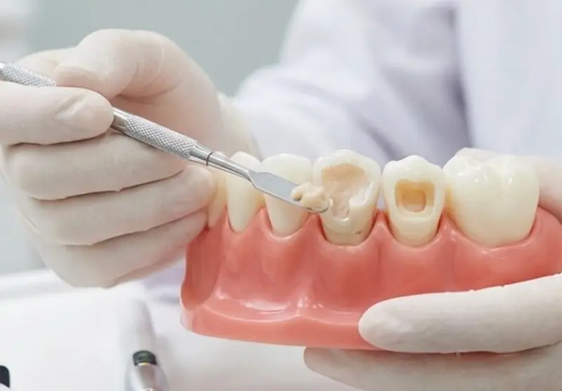 ダイレクトボンディングの解説