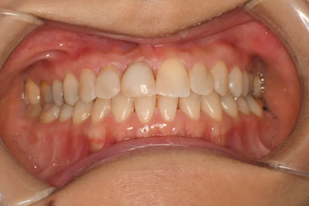 ダイレクトボンディング アフター写真