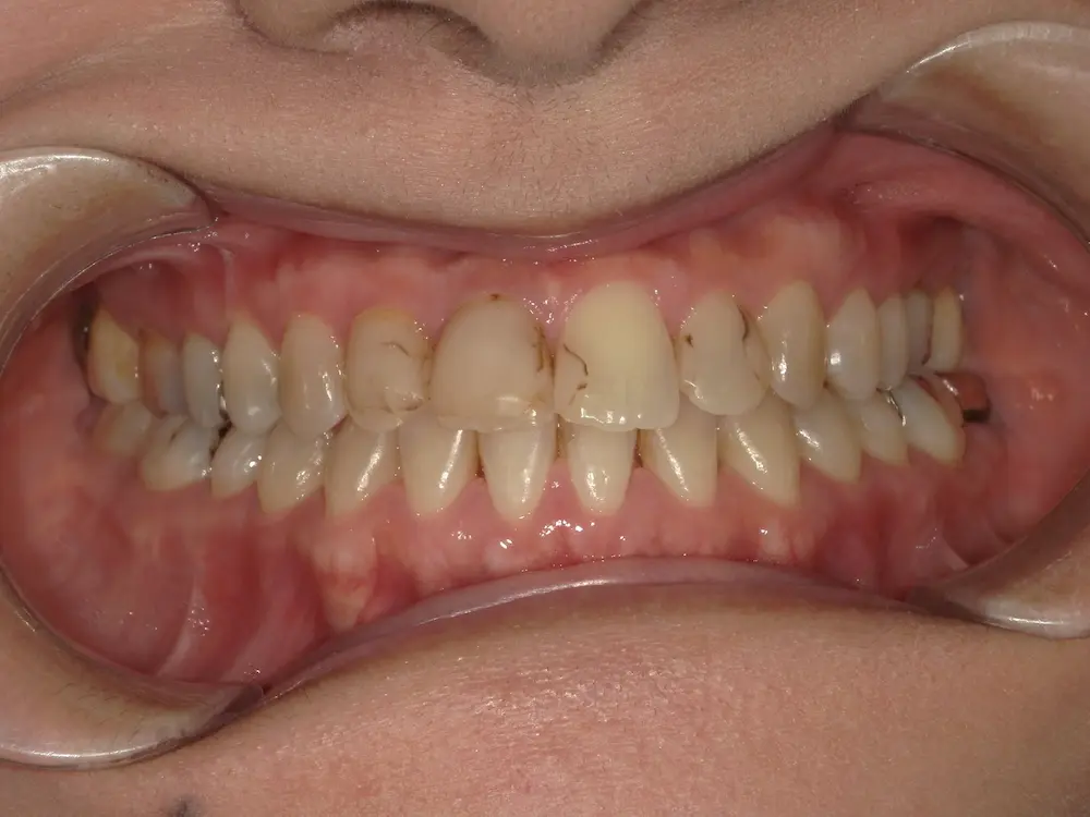 ダイレクトボンディング ビフォー写真