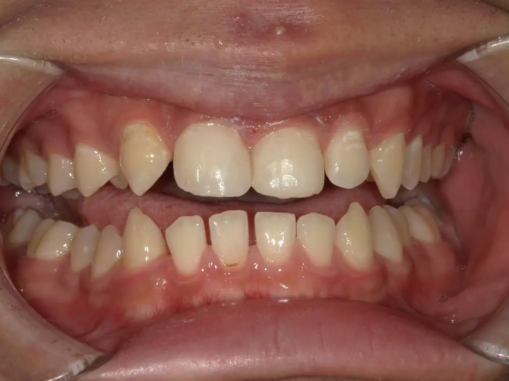 ダイレクトボンディング アフター写真