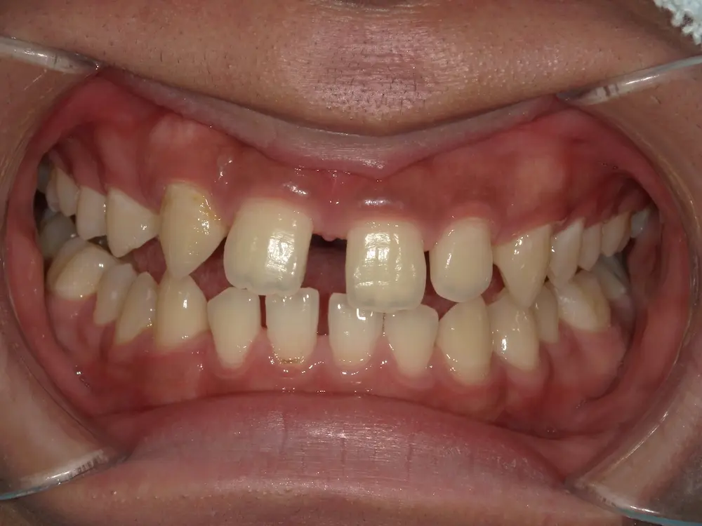 ダイレクトボンディング ビフォー写真