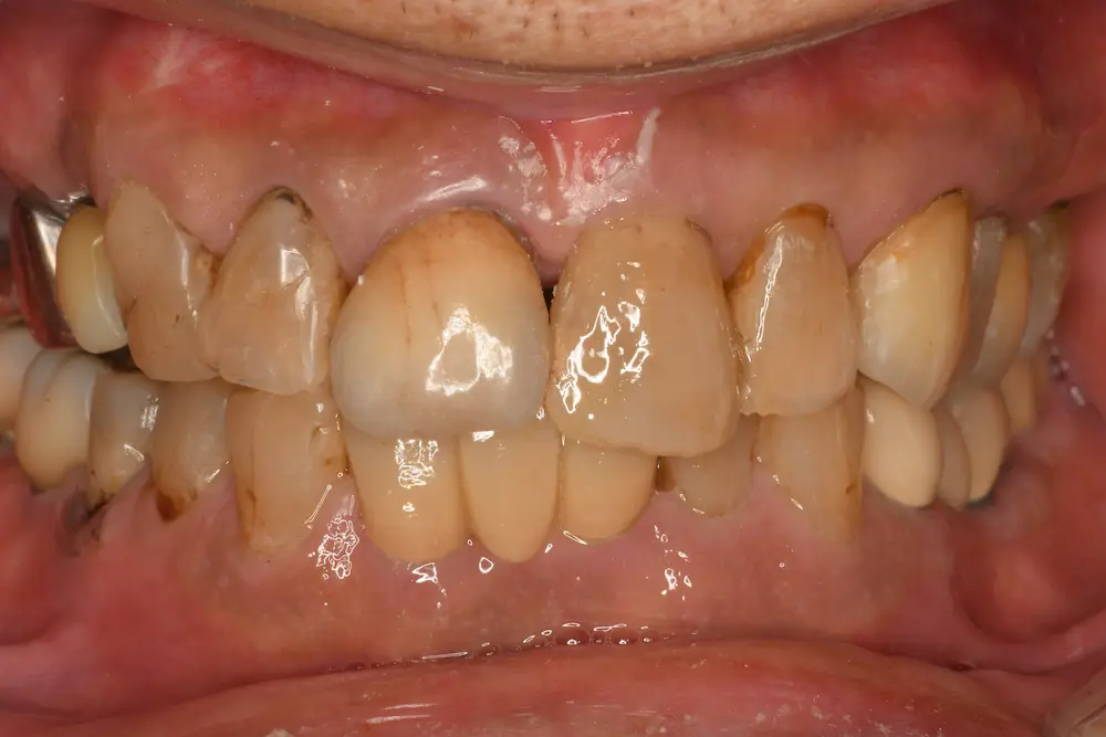 ダイレクトボンディング アフター写真