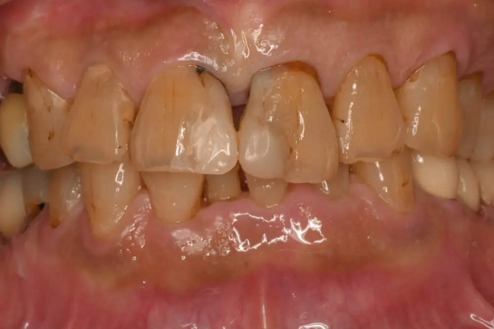 ダイレクトボンディング ビフォー写真