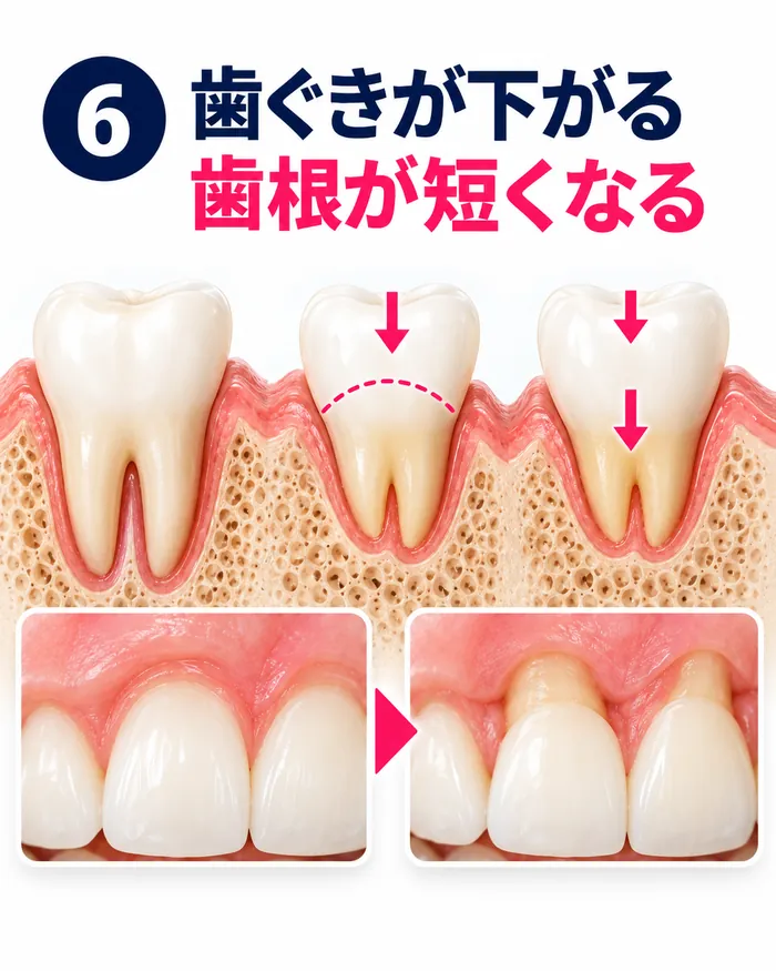 矯正で歯ぐきが下がる・歯根が短くなるリスク 歯肉退縮と歯根吸収で歯ぐきが下がり、歯根が短くなる様子を示した断面図と口の中の比較(イメージ)